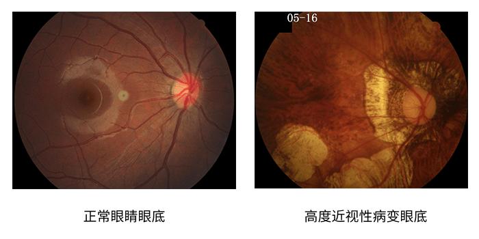 高度近视眼底黄斑病好治吗,高度近视检查眼底就行了吗