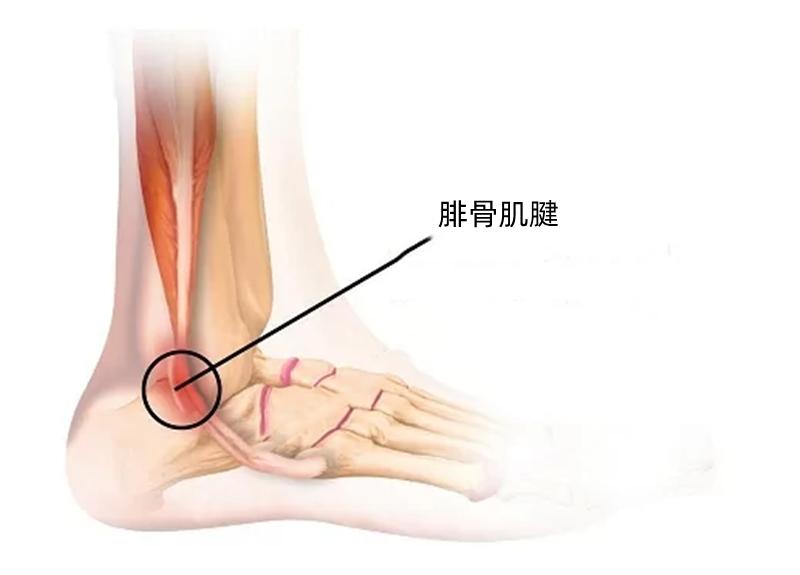 脚踝走路咯咯响怎么回事,走路脚踝发出清脆响声还容易抽筋