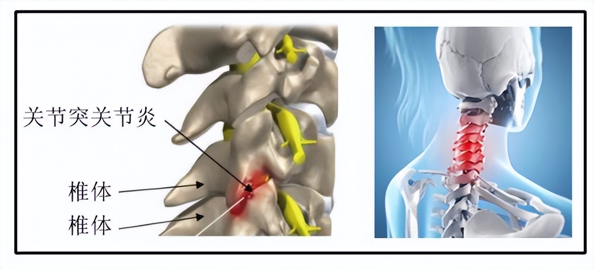 颈痛的最佳治疗方法,最近肩颈疼是什么病毒