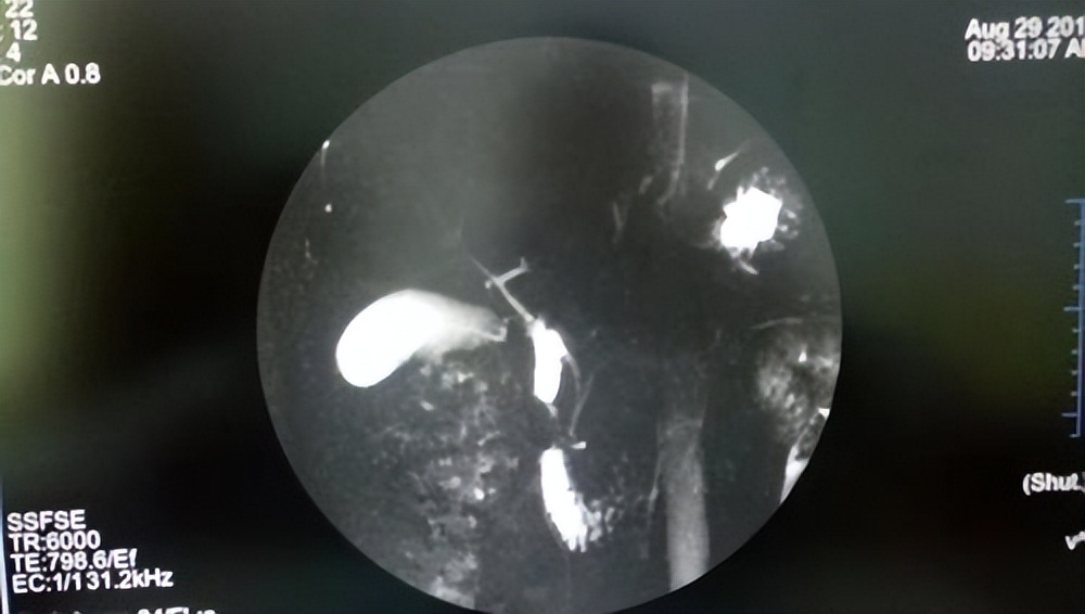 腹腔镜下胆总管切开取石治疗,充填型胆囊结石用腹腔镜怎样切除