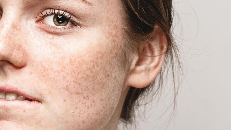 红霉素软膏可以去除老年斑吗,红霉素加阿司匹林老年斑一擦就掉