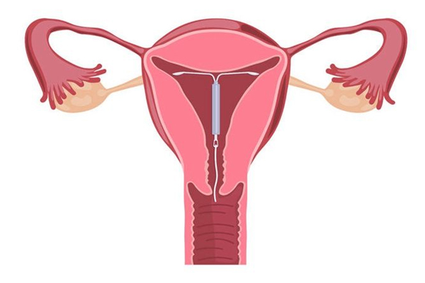安全期避孕用什么方法最安全,安全期避孕是有效的避孕方法