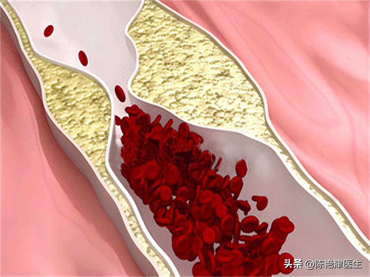 血脂高多少需要吃降脂药,血脂多高需要服用降脂药