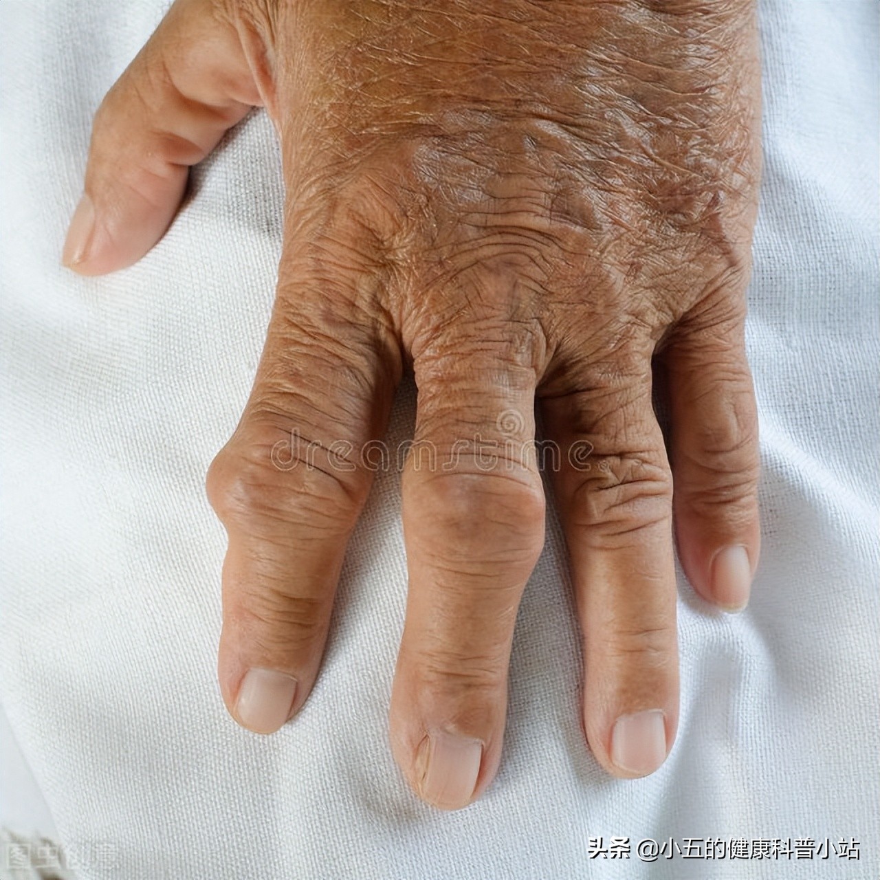 非布司他怎么吃可以根治痛风,吃非布司他痛风发作脚红肿怎么办