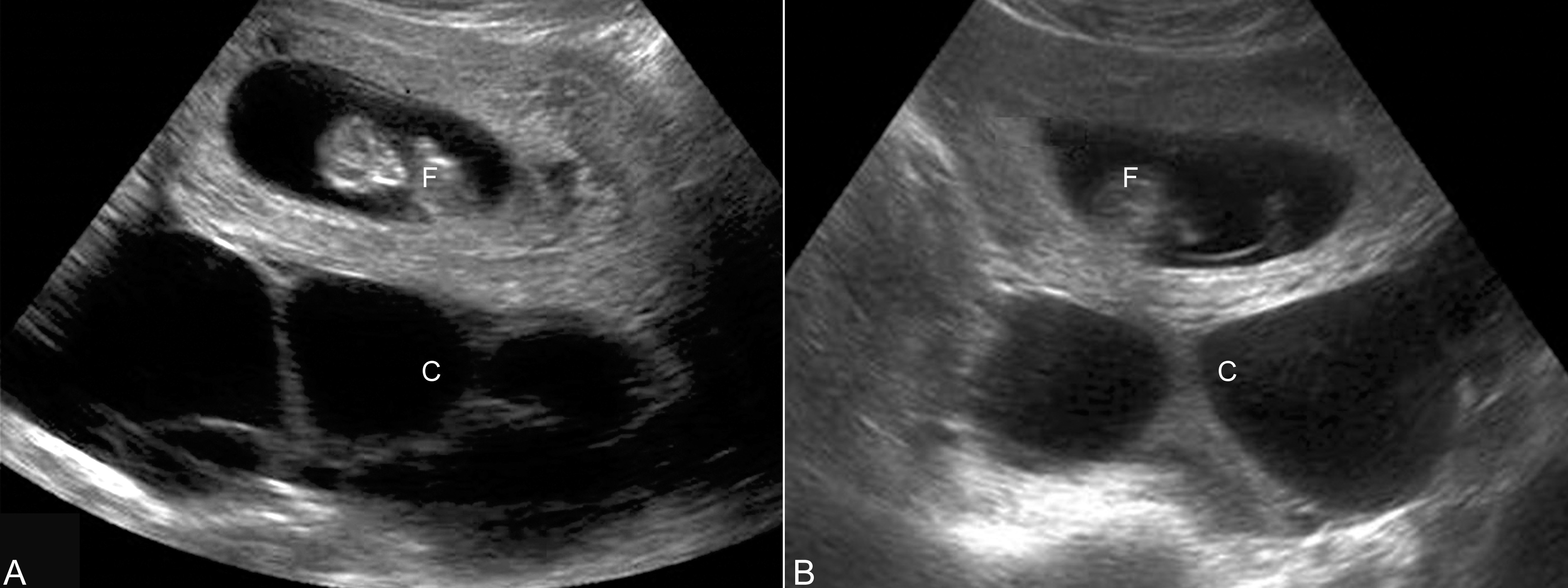 妊娠合并卵巢良性肿瘤,妊娠合并卵巢肿瘤是恶性吗