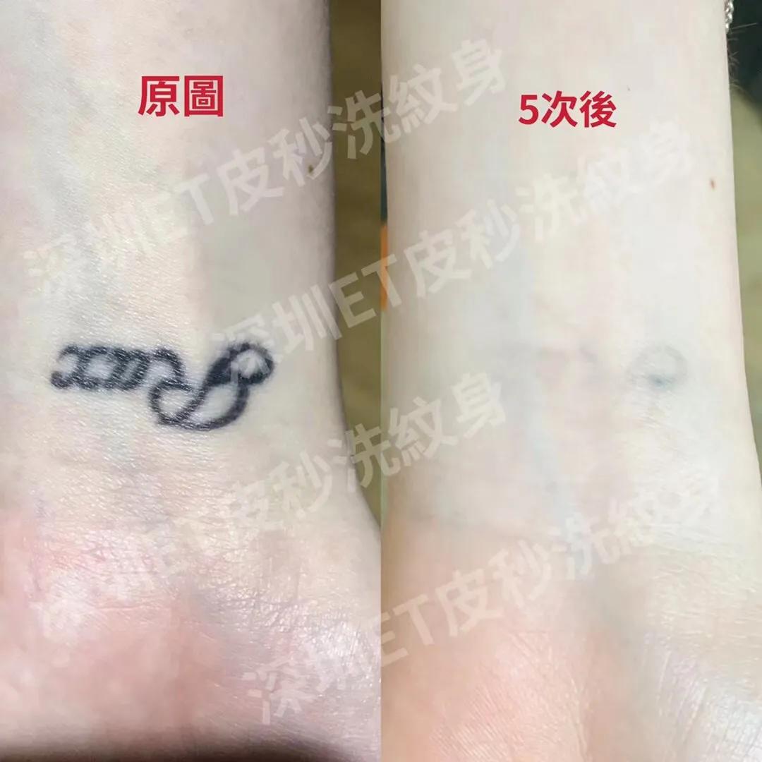 广州一次性洗纹身技术,深圳洗纹身不留疤哪家好