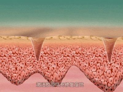 点阵激光是用来干嘛的,点阵激光的副作用和危害