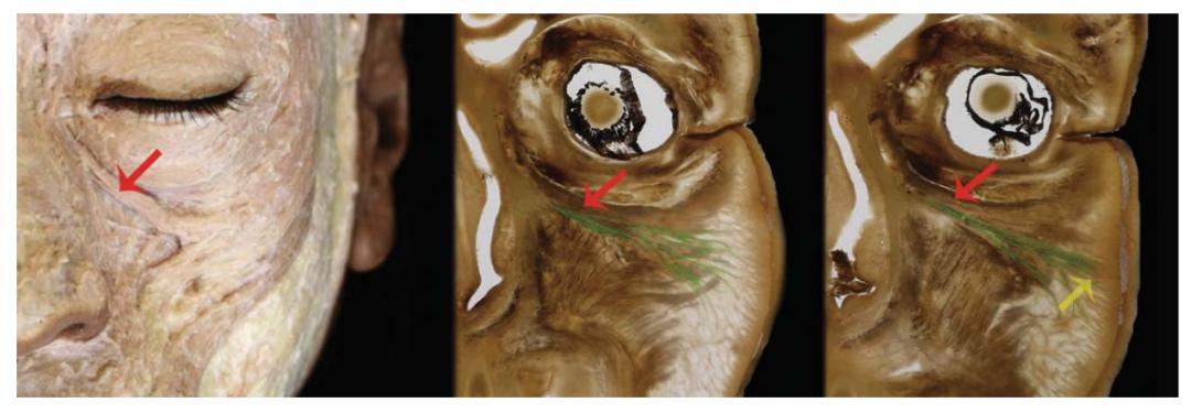 印第安纹解剖学,印第安纹分型对策