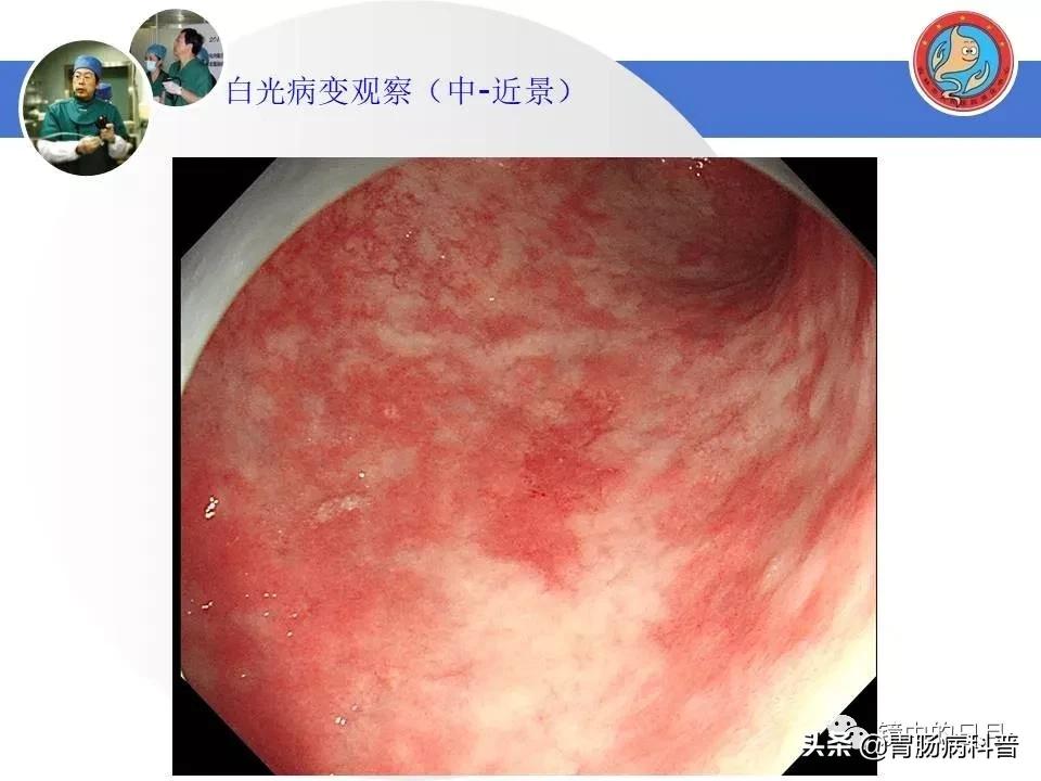 胃癌可以做内镜手术吗,早期胃癌内镜手术后追加外科手术