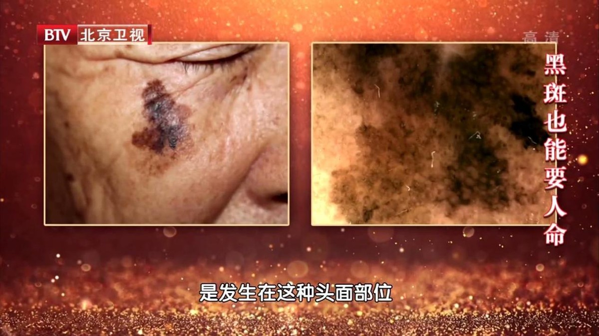 皮肤上有黑点是癌症的前兆吗,皮肤长出红点要注意癌症的表现