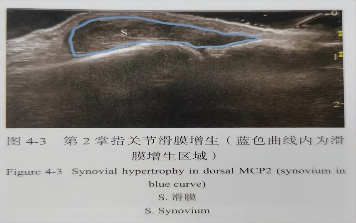 什么是肌骨超声为什么风湿病患者要做肌骨超声？