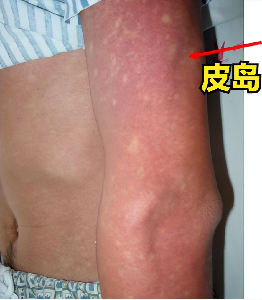 预防控制登革热最佳的措施是灭蚊,登革热的症状及预防措施