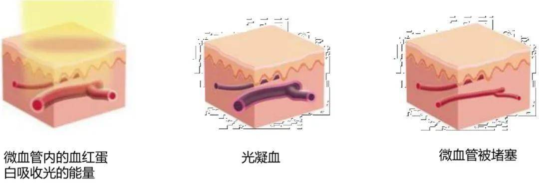 治疗疤痕增生的四种方法,你知道几个?