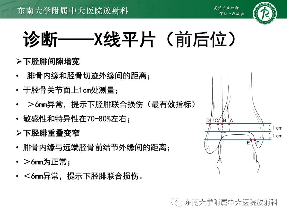 左腓骨下段骨折伴下胫腓联合分离,好文分享深度揭秘