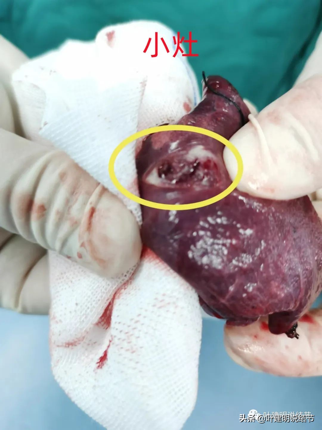 病例分享：这种样子的错构瘤？我是第一次见