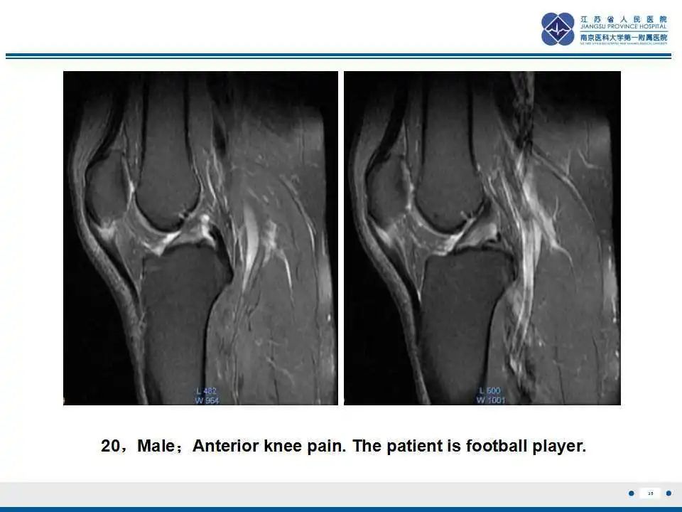 胫骨结节软骨炎要怎么治疗,胫骨结节骨软骨炎会癌变吗