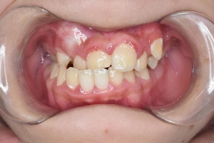 徐州儿童牙齿矫正牙齿不齐,大连口腔医院儿童牙齿矫正怎么样