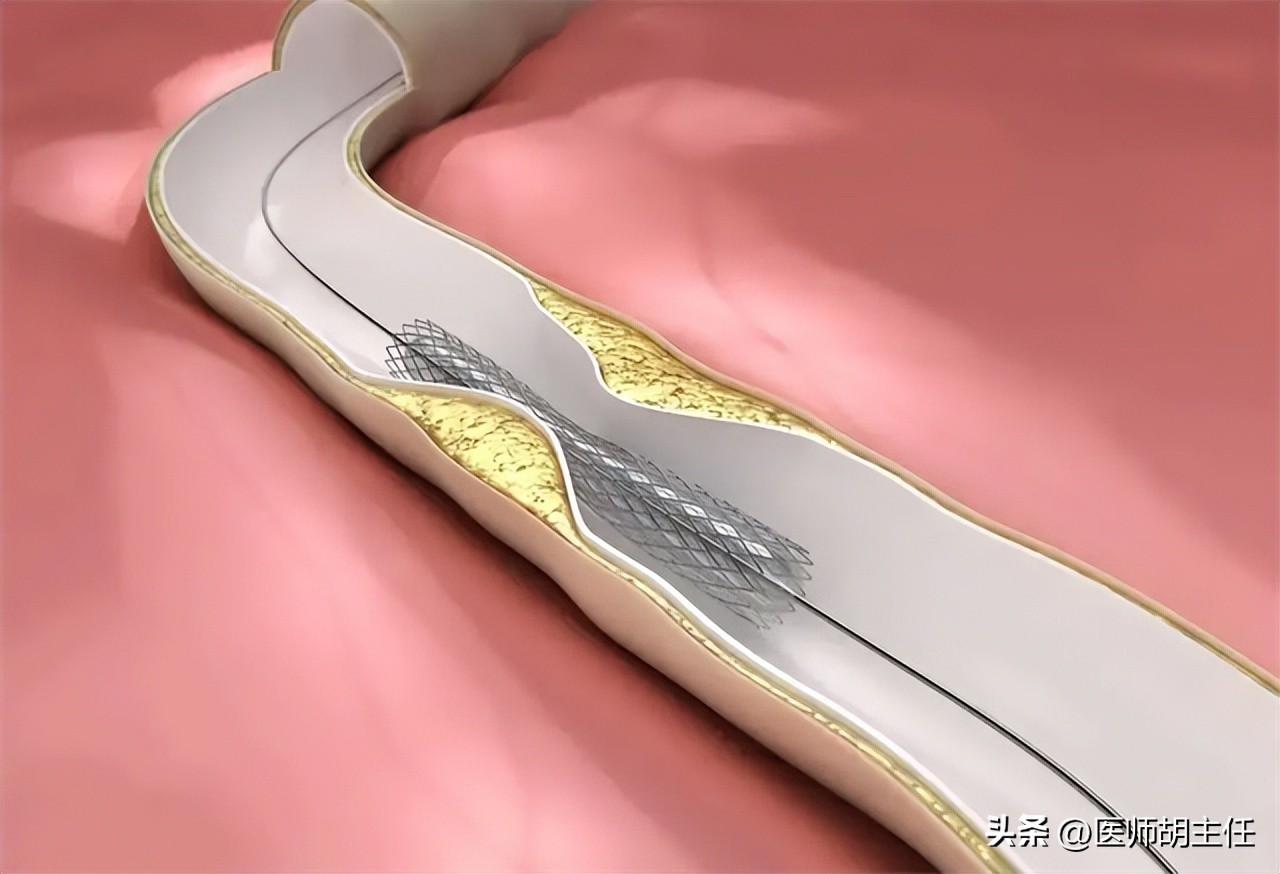 做冠状动脉造影对人体有副作用吗,做完冠脉造影后血管会变脆吗