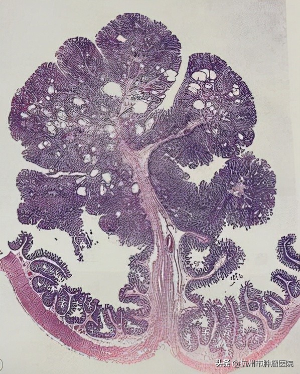 口唇黑斑是息肉还是肿瘤,嘴唇黑斑查出肠癌