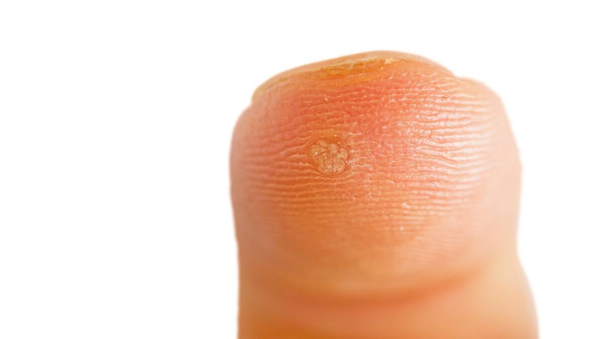 寻常疣扁平疣和跖疣,寻常疣与扁平疣哪个严重