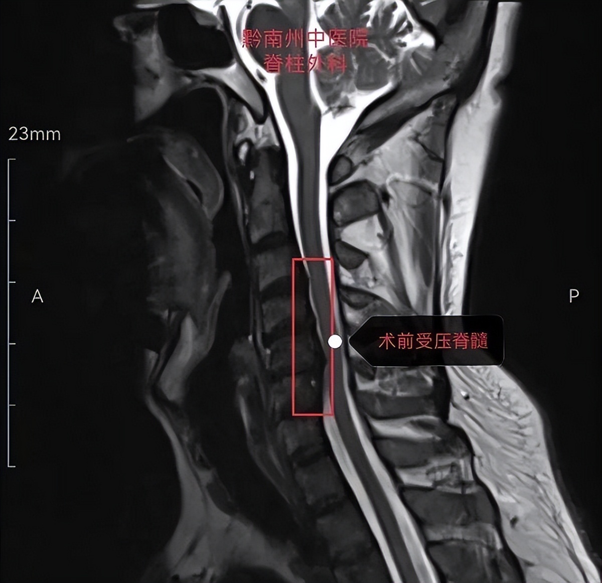 脊柱外科的最新突破,贵州中医二附院脊柱骨科