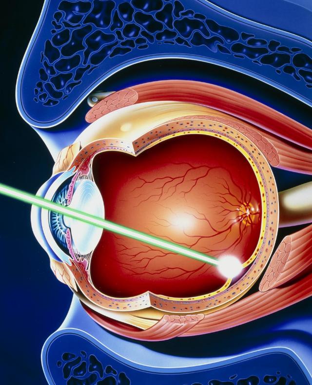 激光手术治近视眼十年后视力模糊,用激光手术治疗近视的人