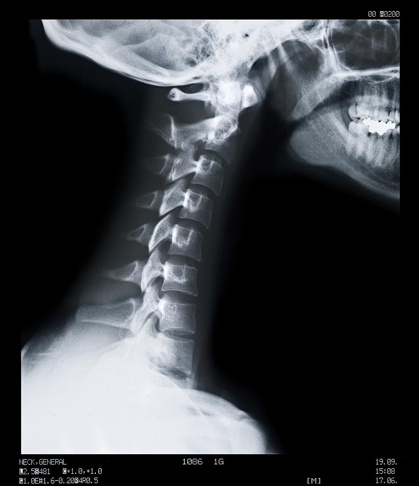 颈椎疼痛的自救指南,颈椎疼痛一招解决太神奇了