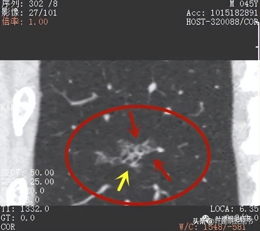 肺蜂窝状改变是肺癌吗,肺部陈旧灶与肿瘤怎么确诊