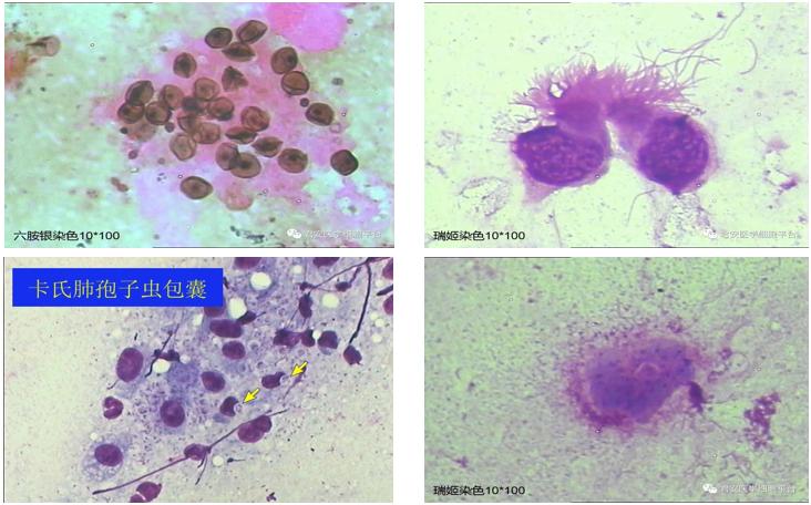 hiv感染肺孢子菌肺炎,hiv患者检查出耶氏肺孢子菌