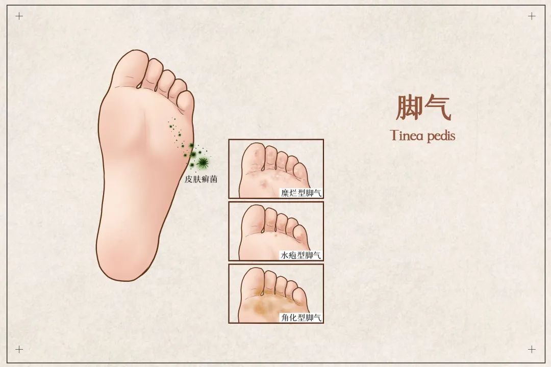 一到夏天脚气就反复发作,一到夏天就有脚气这个方法教给你