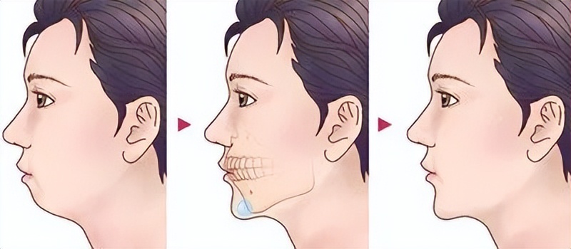 下巴后缩是不是最难看的,下巴后缩明星怎么改善