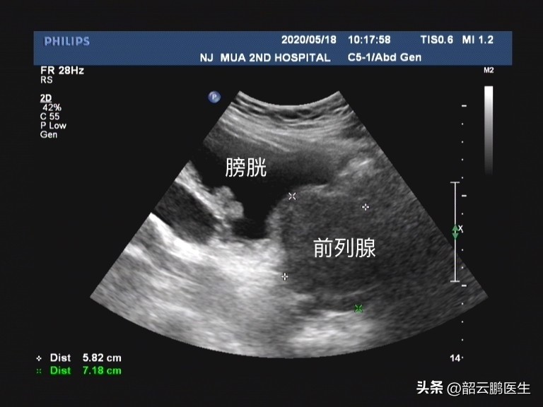 内消瘰疬丸治不治前列腺增生,前列腺增生可以做什么运动改善吗