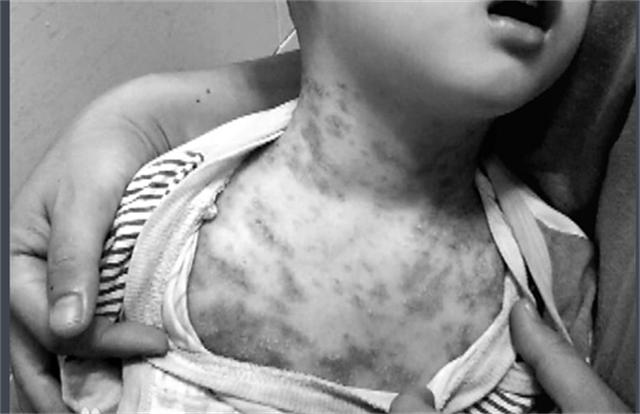 孩子药浴洗出绝症母亲肠子悔青,给孩子洗药浴洗出绝症