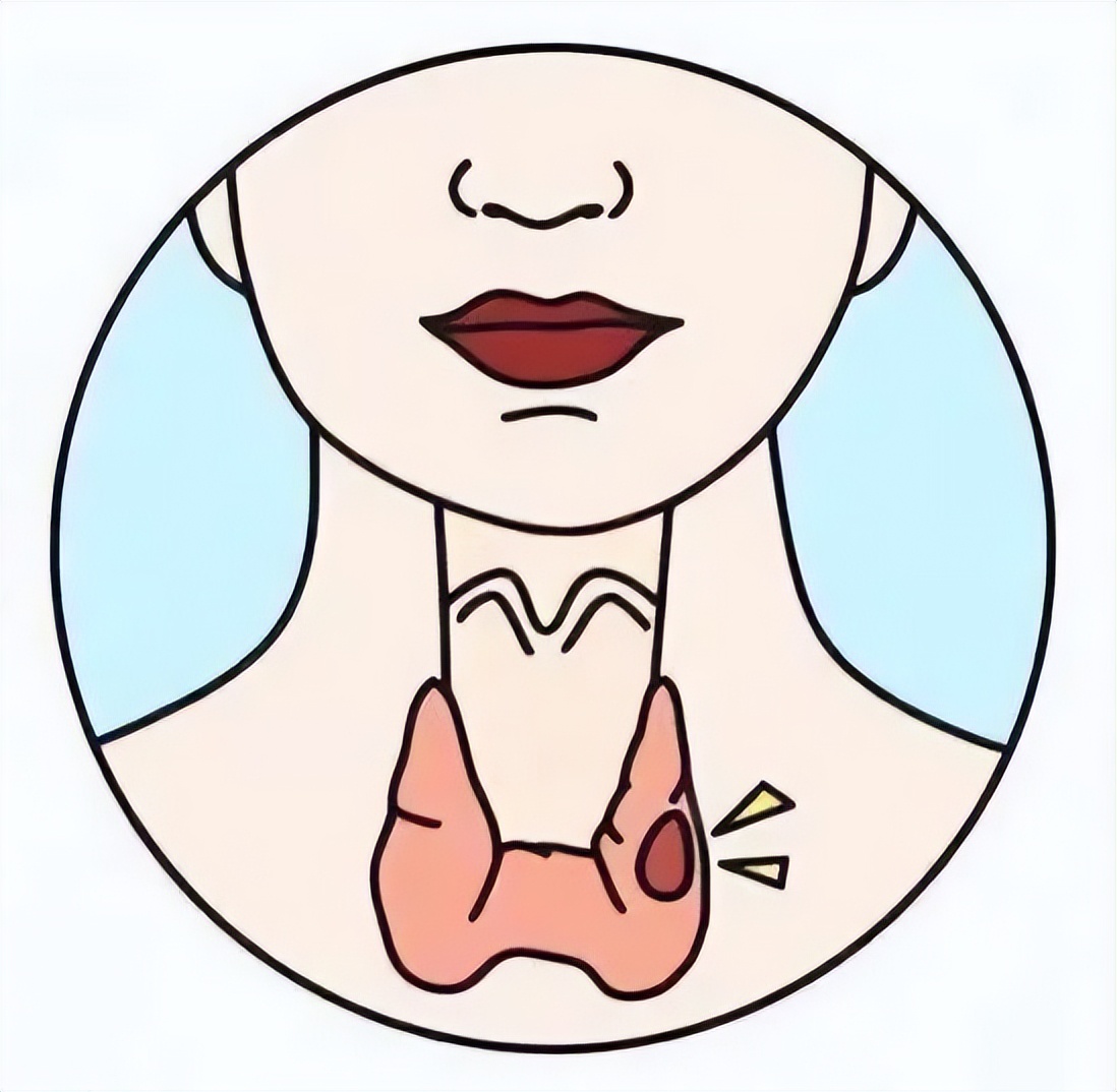甲状腺癌是“懒癌”?别低估其破坏力