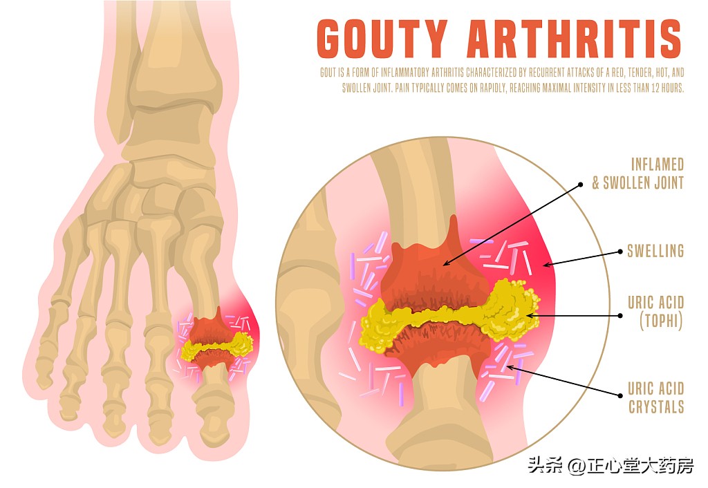 真痛风假痛风怎么鉴别最准确,痛风为什么每个医生都说的不一样