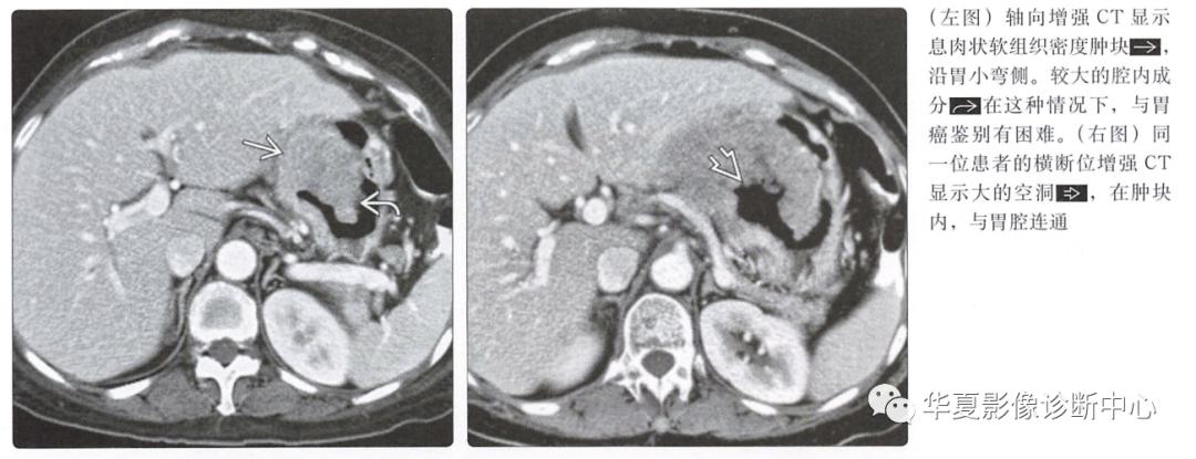 胃肠道间质瘤,胃肠间质瘤tki治疗