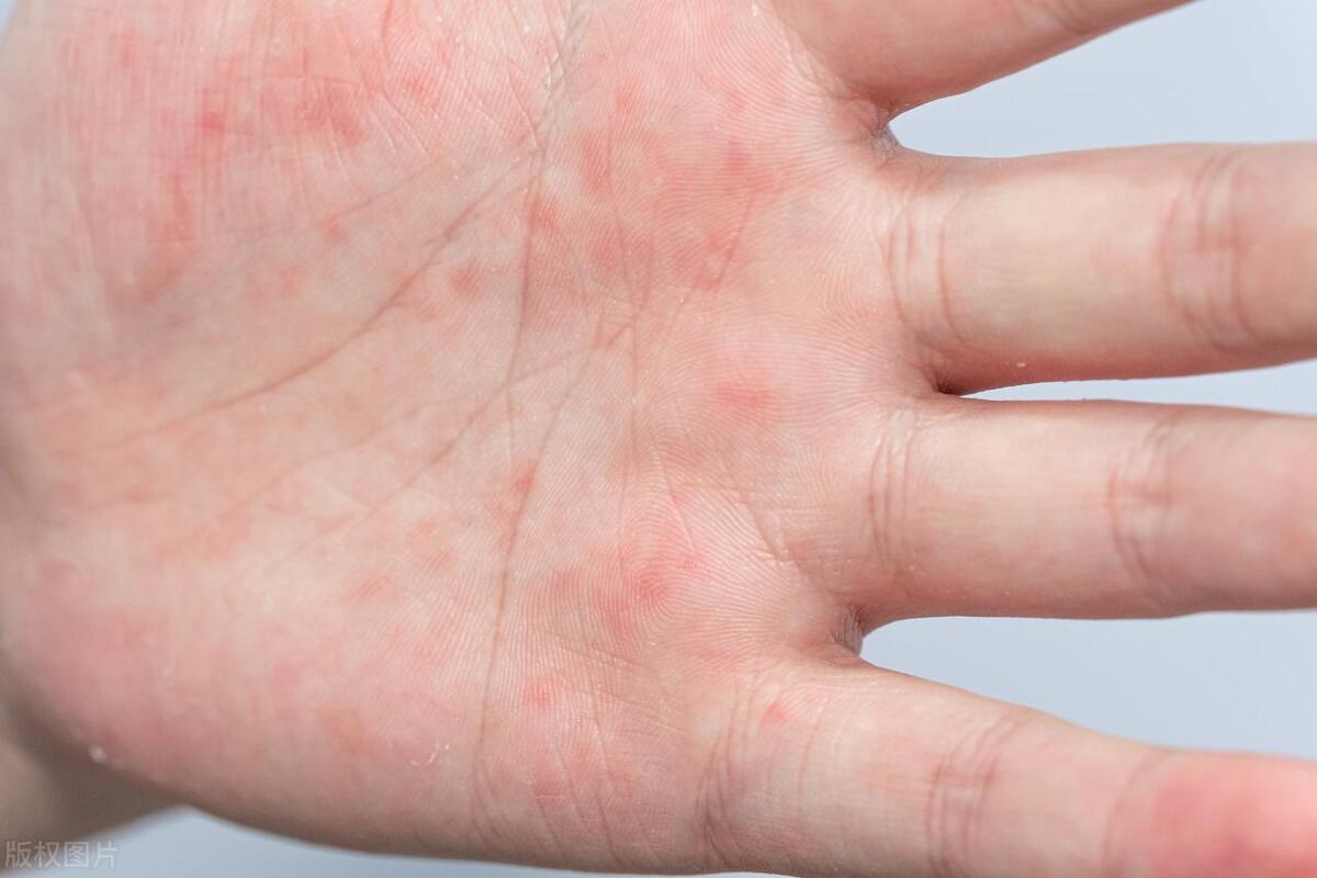 突发汗疱疹怎么办,如何缓解汗疱疹的灼热