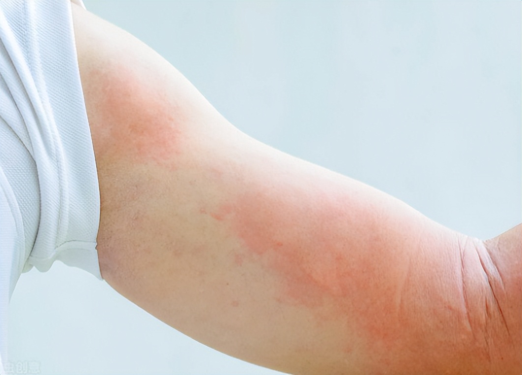 过敏洗澡能用沐浴露吗,为什么有人一洗澡就过敏