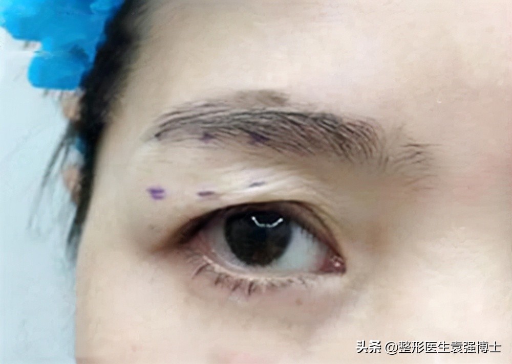 做完提眉和眼袋该注意些什么,做完提眉出现褶皱