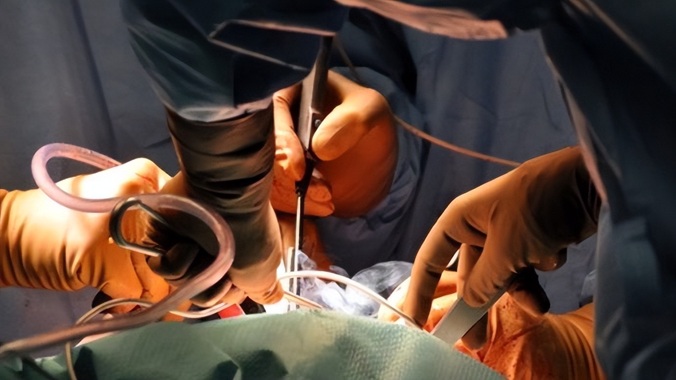 体检发现胆结石，胆囊到底切不切？