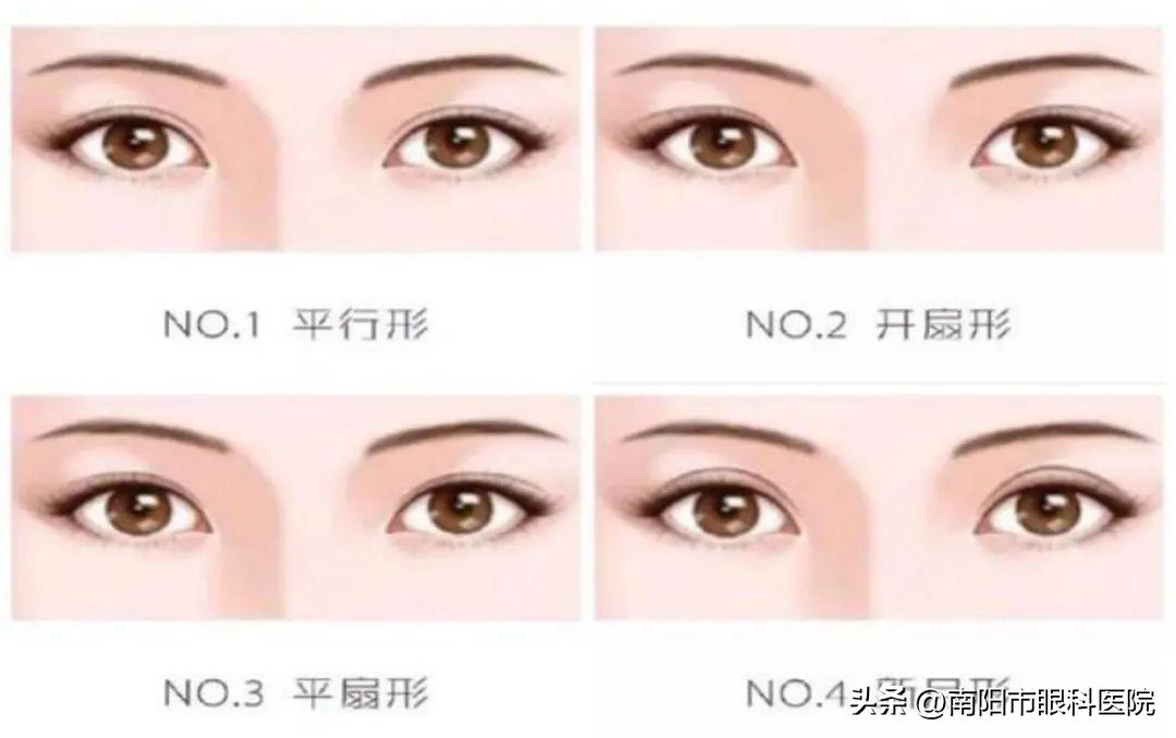 双眼皮整形方式有几种哪种好一些,整形双眼皮有几种款式