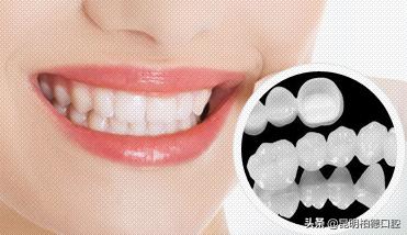 牙齿掉了一半做烤瓷牙全过程,有关牙齿那些事儿
