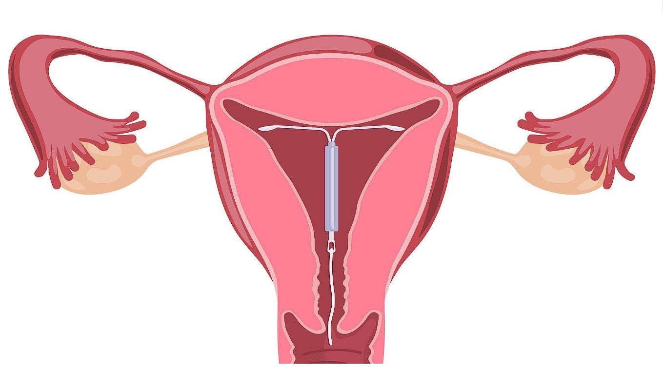女性上环30年后的结局,以前上环的女性30多年后现状如何