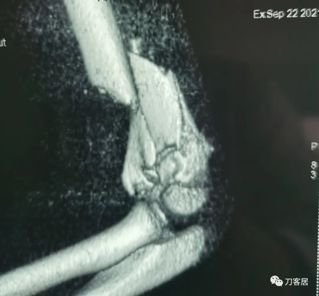 孩子胳膊摔伤肿了不能弯曲一直疼,9岁男孩摔倒手臂痛怎么办