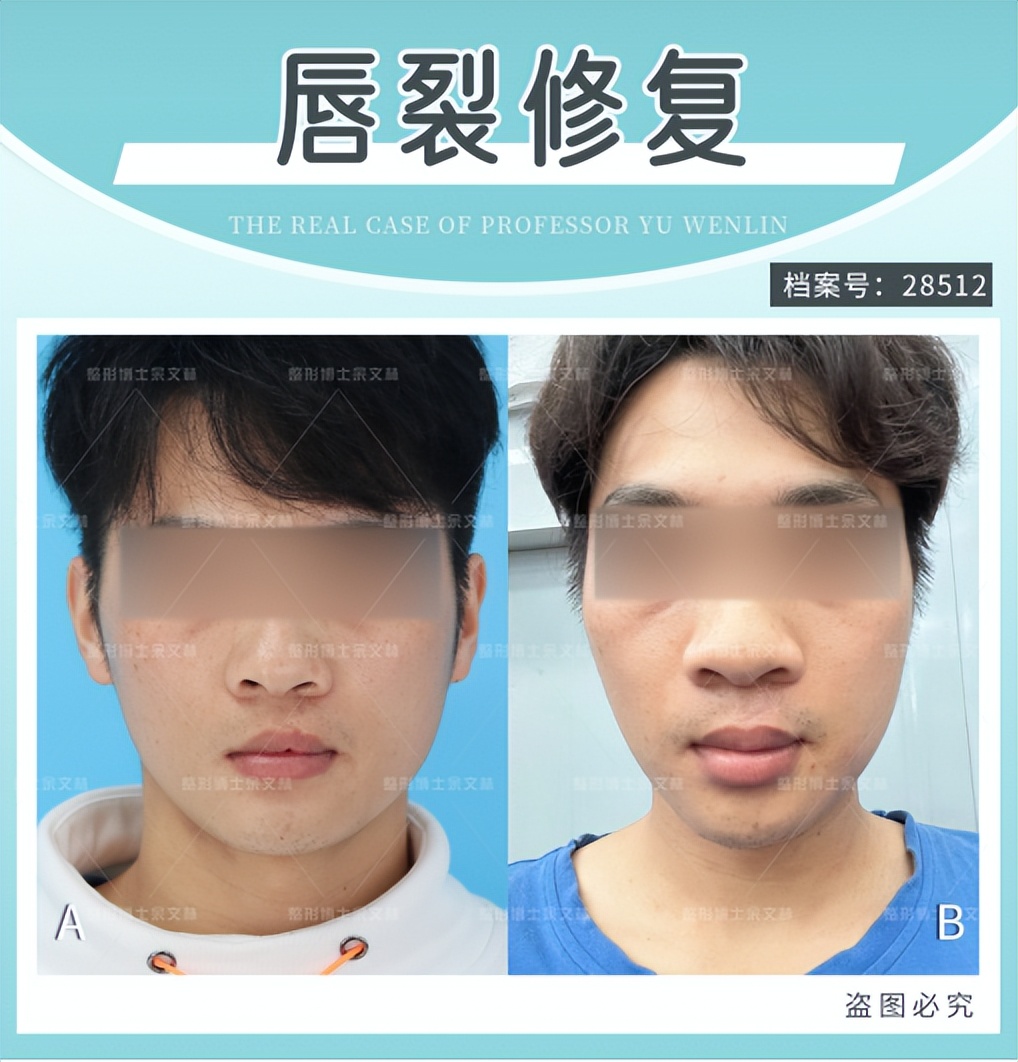 唇裂伴牙槽裂修复效果,唇裂二次修复手术费用