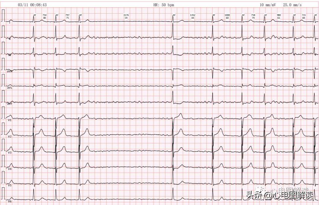 心房颤动伴长间歇能做射频消融吗,心房颤动伴停搏严重么