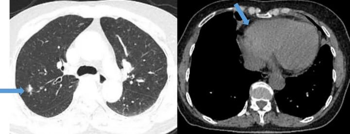 中耳炎引起耳朵越来越聋,小小的中耳炎为什么治不好