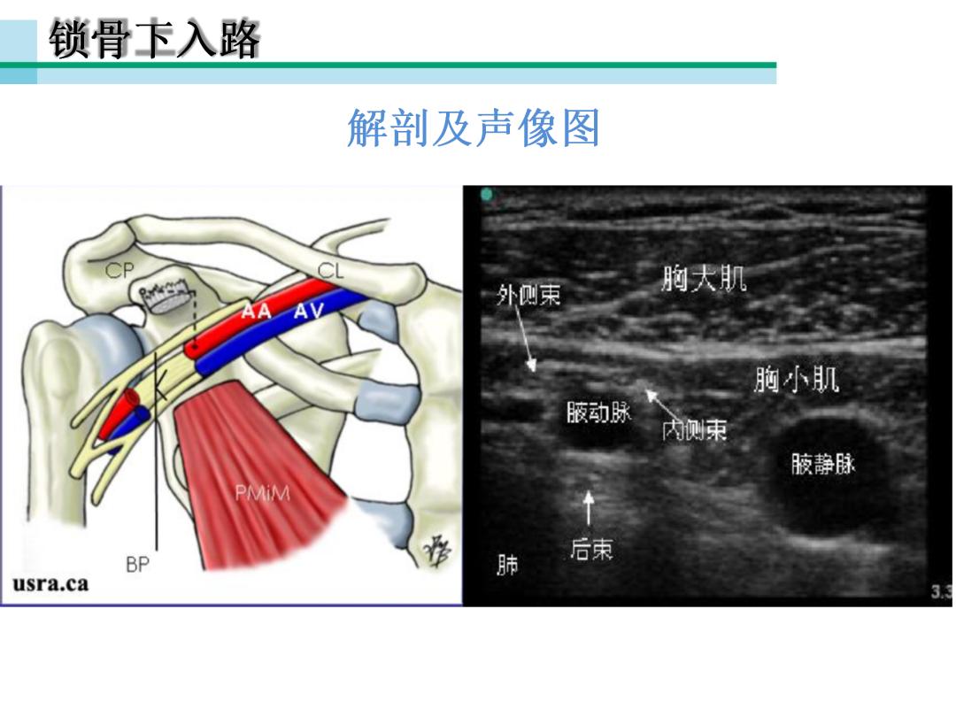 超声引导下臂丛神经阻滞,PPT课件