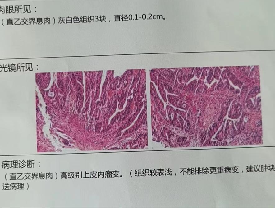 便血怎么分辨痔疮和息肉,便血是肠息肉还是肠癌