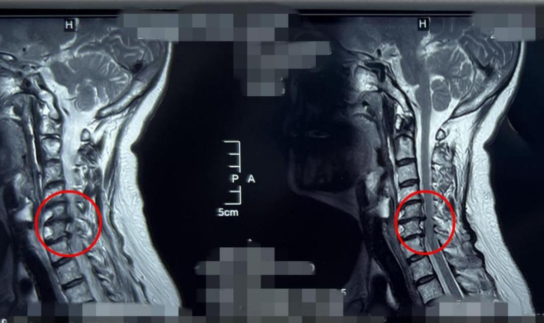 西安椎间孔镜手术治疗颈椎,西安红会医院微创